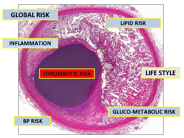 GLOBAL RISK LIPID RISK INFLAMMATION THROMBOTIC RISK LIFE STYLE GLUCO-METABOLIC RISK BP RISK 