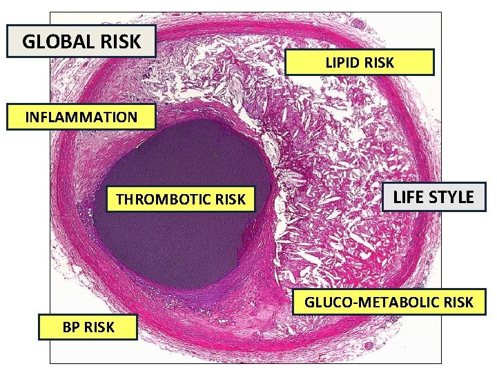 GLOBAL RISK LIPID RISK INFLAMMATION THROMBOTIC RISK LIFE STYLE GLUCO-METABOLIC RISK BP RISK 