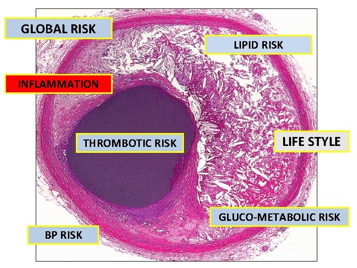 GLOBAL RISK LIPID RISK INFLAMMATION THROMBOTIC RISK LIFE STYLE GLUCO-METABOLIC RISK BP RISK 