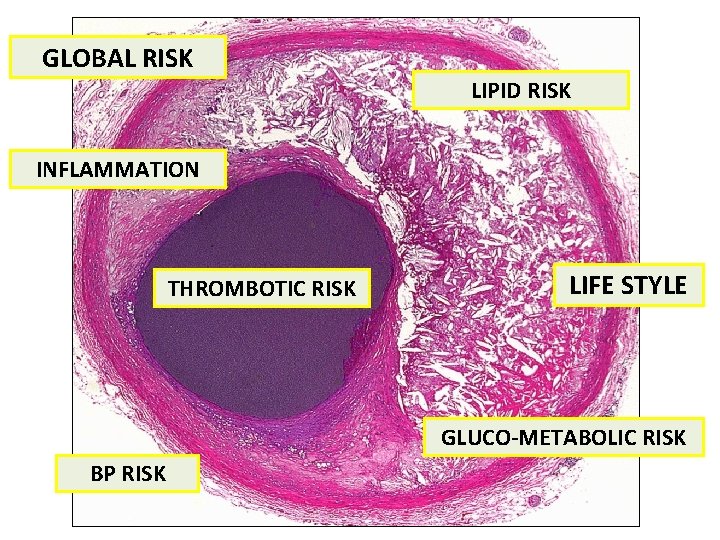 GLOBAL RISK LIPID RISK INFLAMMATION THROMBOTIC RISK LIFE STYLE GLUCO-METABOLIC RISK BP RISK 