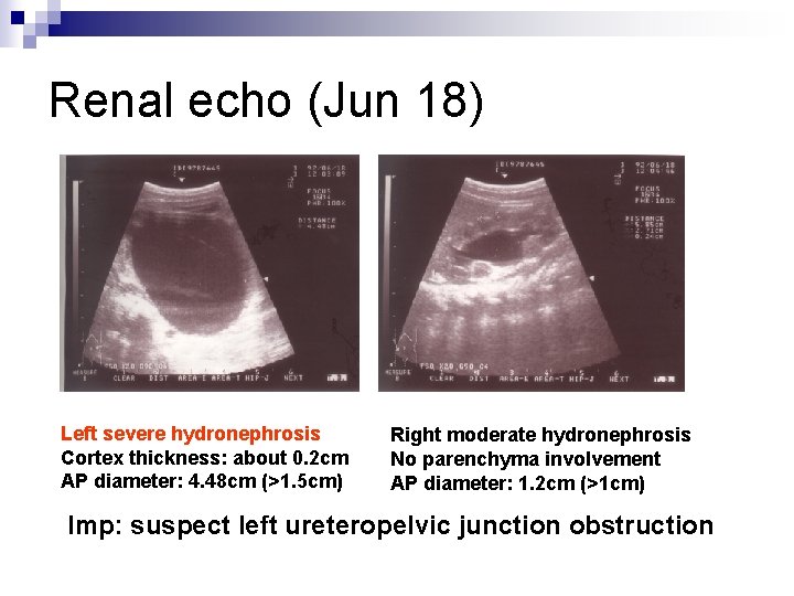 Renal echo (Jun 18) Left severe hydronephrosis Cortex thickness: about 0. 2 cm AP