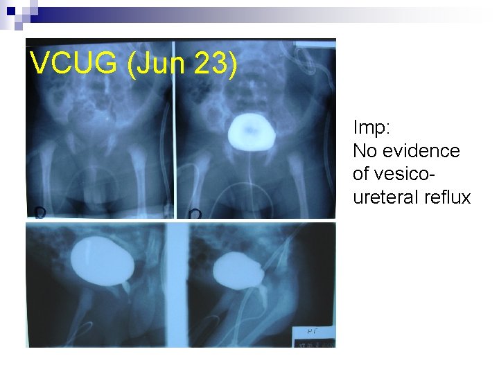 VCUG (Jun 23) Imp: No evidence of vesicoureteral reflux 