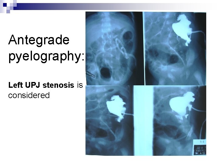 Antegrade pyelography: Left UPJ stenosis is considered 