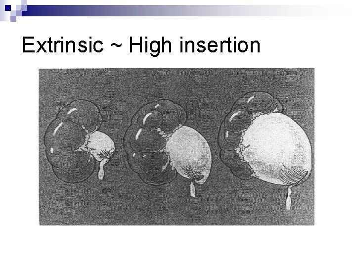 Extrinsic ~ High insertion 