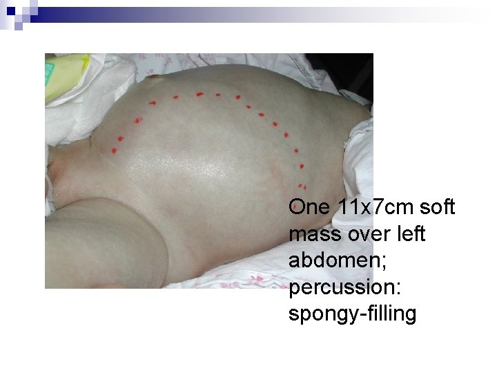 One 11 x 7 cm soft mass over left abdomen; percussion: spongy-filling 