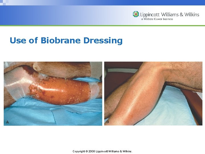 Use of Biobrane Dressing Copyright © 2008 Lippincott Williams & Wilkins. 