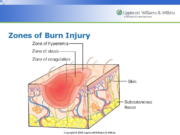 Zones of Burn Injury Copyright © 2008 Lippincott Williams & Wilkins. 