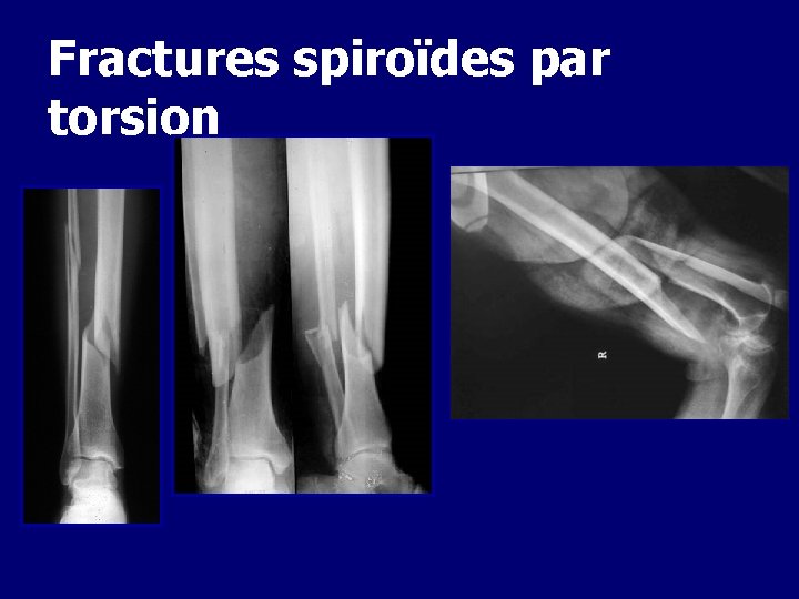 Fractures spiroïdes par torsion 