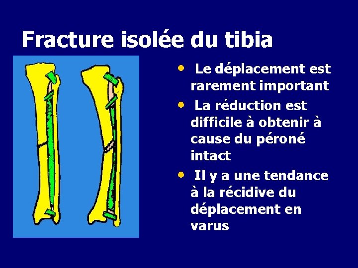 Fracture isolée du tibia • Le déplacement est • • rarement important La réduction