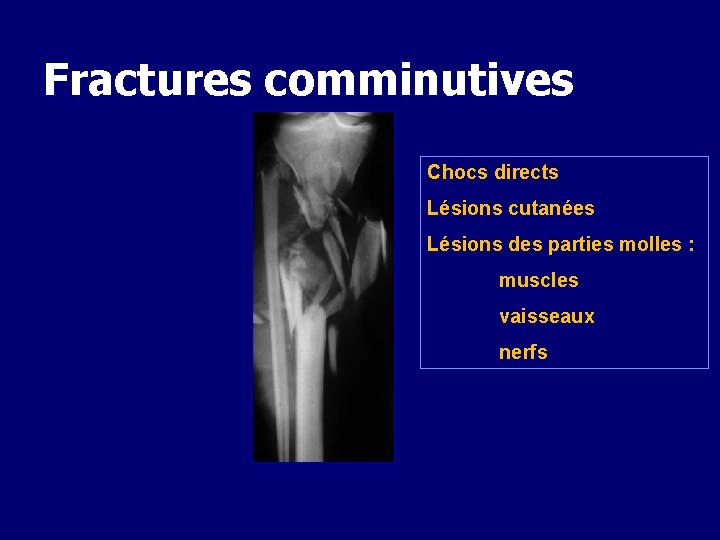 Fractures comminutives Chocs directs Lésions cutanées Lésions des parties molles : muscles vaisseaux nerfs