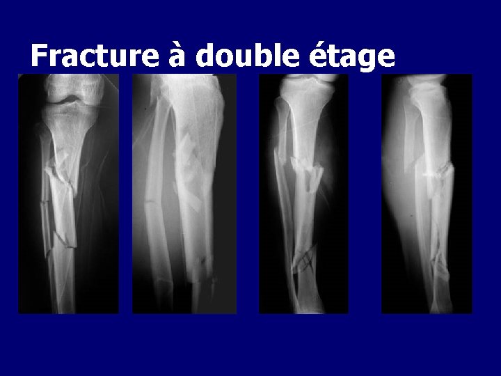 Fracture à double étage 