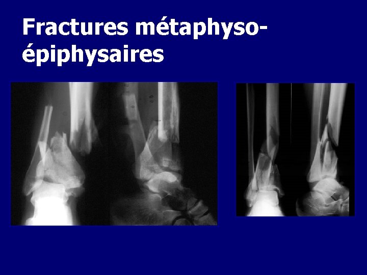 Fractures métaphysoépiphysaires 