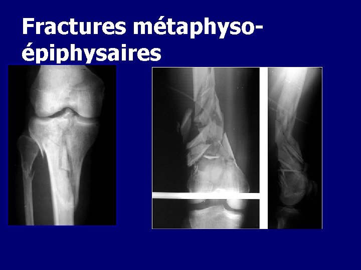 Fractures métaphysoépiphysaires 