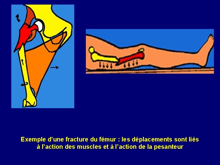 Exemple d’une fracture du fémur : les déplacements sont liés à l’action des muscles