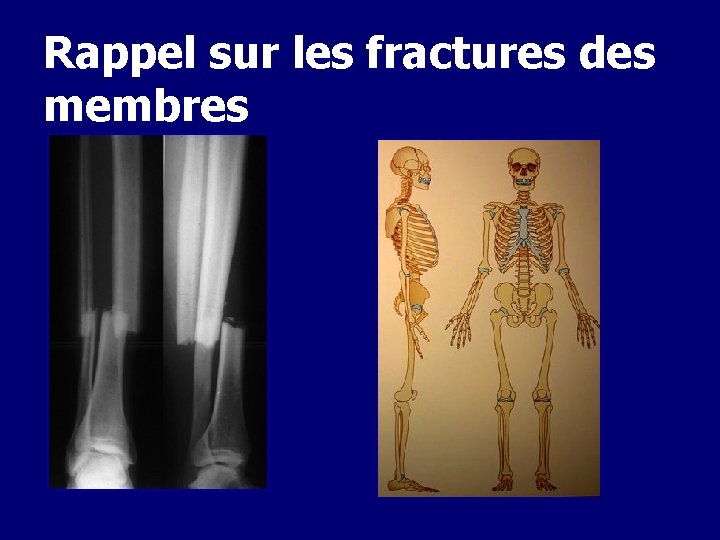 Rappel sur les fractures des membres 