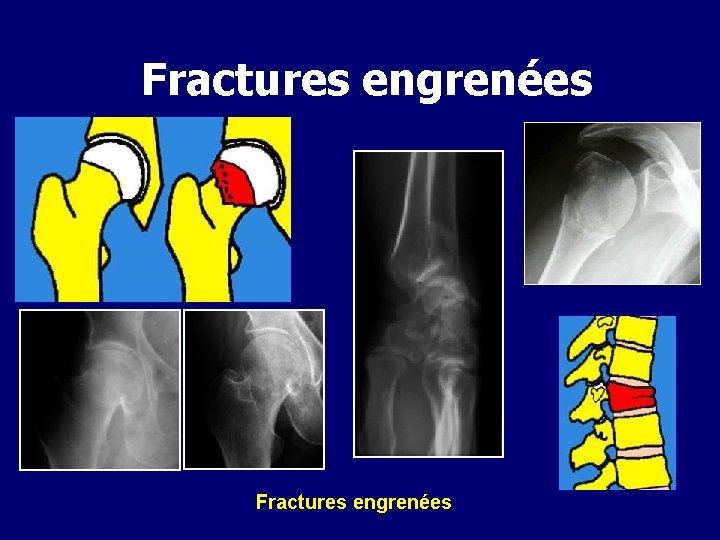Fractures engrenées 