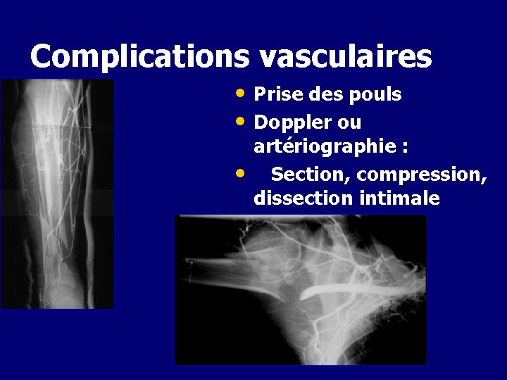 Complications vasculaires • Prise des pouls • Doppler ou • artériographie : Section, compression,