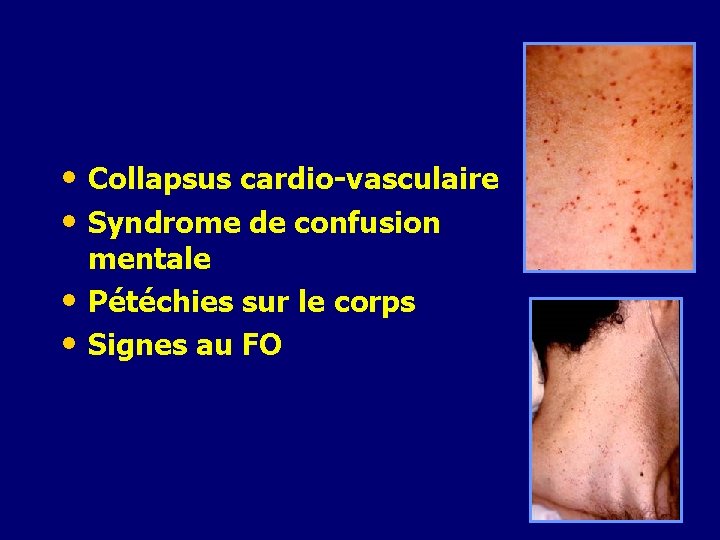  • Collapsus cardio-vasculaire • Syndrome de confusion mentale • Pétéchies sur le corps