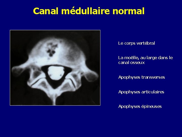 Canal médullaire normal Le corps vertébral La moêlle, au large dans le canal osseux