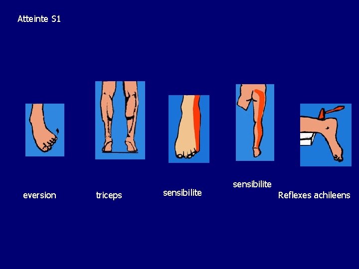 Atteinte S 1 eversion triceps sensibilite Reflexes achileens 