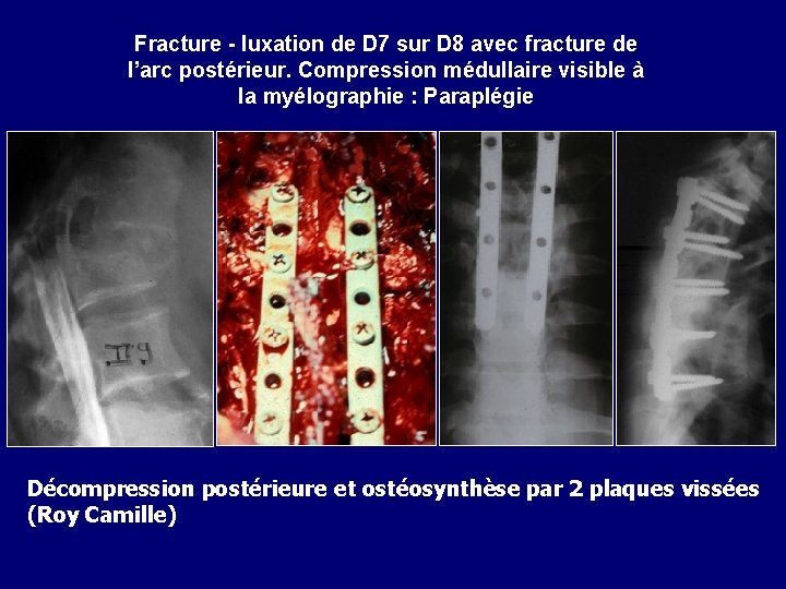 Fracture - luxation de D 7 sur D 8 avec fracture de l’arc postérieur.