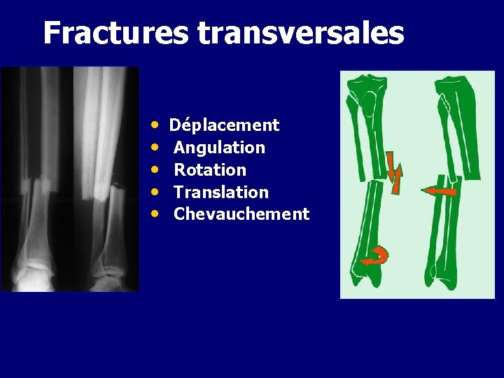 Fractures transversales • • • Déplacement Angulation Rotation Translation Chevauchement 