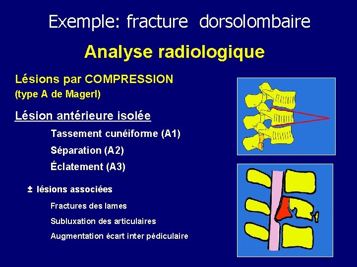 Exemple: fracture dorsolombaire Analyse radiologique Lésions par COMPRESSION (type A de Magerl) Lésion antérieure