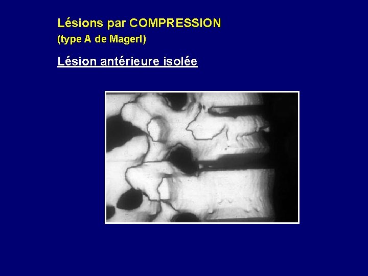 Lésions par COMPRESSION (type A de Magerl) Lésion antérieure isolée 