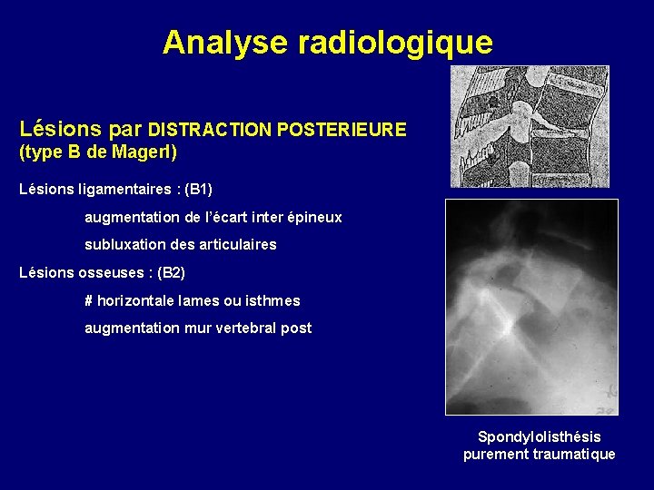 Analyse radiologique Lésions par DISTRACTION POSTERIEURE (type B de Magerl) Lésions ligamentaires : (B