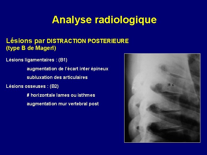 Analyse radiologique Lésions par DISTRACTION POSTERIEURE (type B de Magerl) Lésions ligamentaires : (B