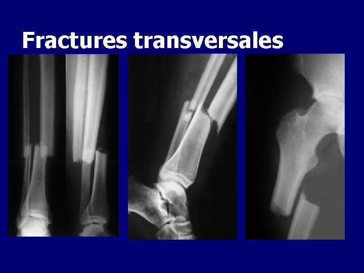 Fractures transversales 