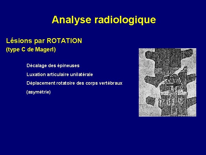 Analyse radiologique Lésions par ROTATION (type C de Magerl) Décalage des épineuses Luxation articulaire
