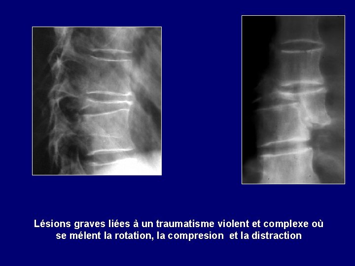 Lésions graves liées à un traumatisme violent et complexe où se mélent la rotation,