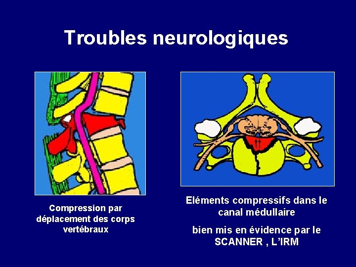 Troubles neurologiques Compression par déplacement des corps vertébraux Eléments compressifs dans le canal médullaire