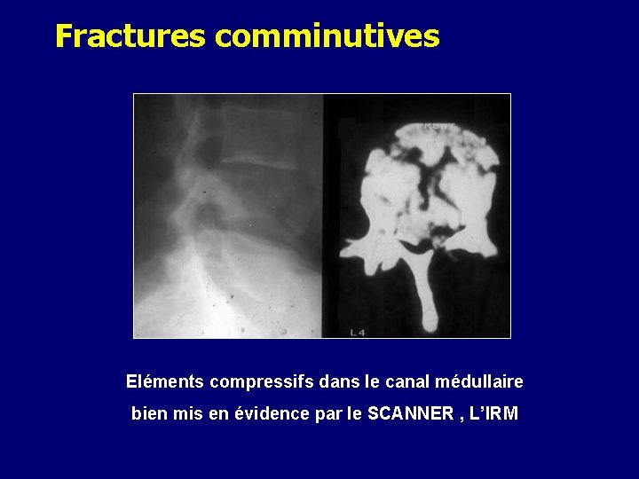 Fractures comminutives Eléments compressifs dans le canal médullaire bien mis en évidence par le