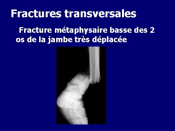 Fractures transversales Fracture métaphysaire basse des 2 os de la jambe très déplacée 