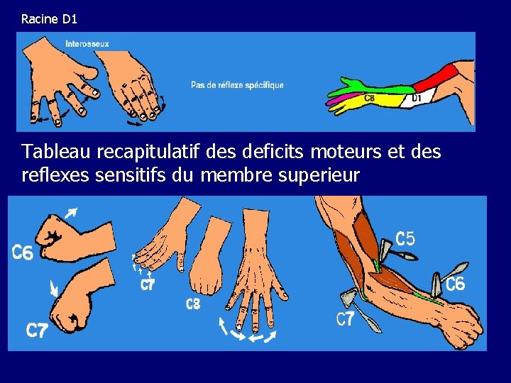 Racine D 1 Tableau recapitulatif des deficits moteurs et des reflexes sensitifs du membre