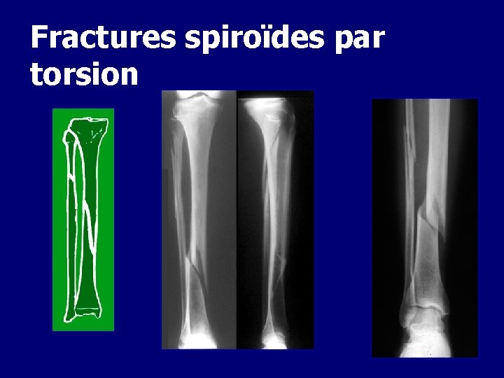 Fractures spiroïdes par torsion 