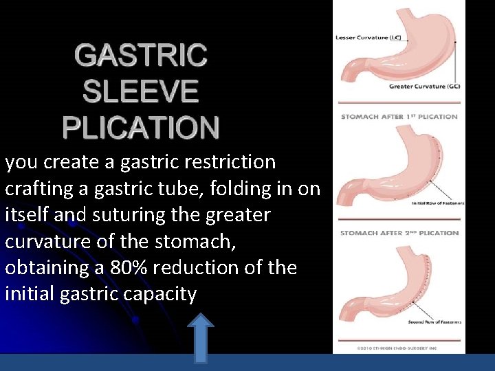 you create a gastric restriction crafting a gastric tube, folding in on itself and