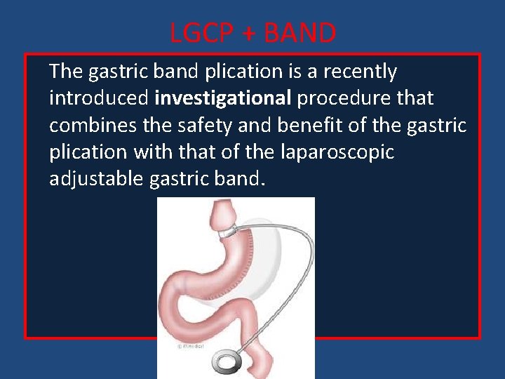 LGCP + BAND The gastric band plication is a recently introduced investigational procedure that