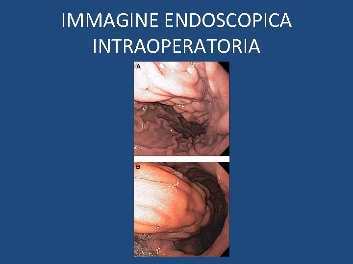 IMMAGINE ENDOSCOPICA INTRAOPERATORIA 