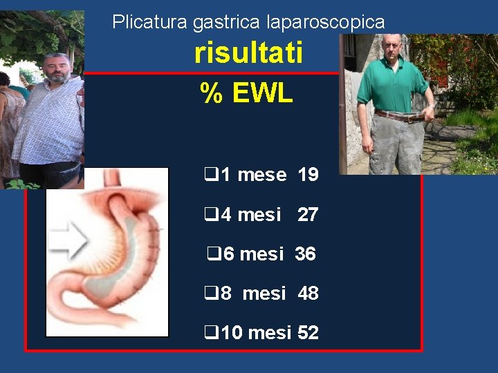 Plicatura gastrica laparoscopica risultati % EWL q 1 mese 19 q 4 mesi 27