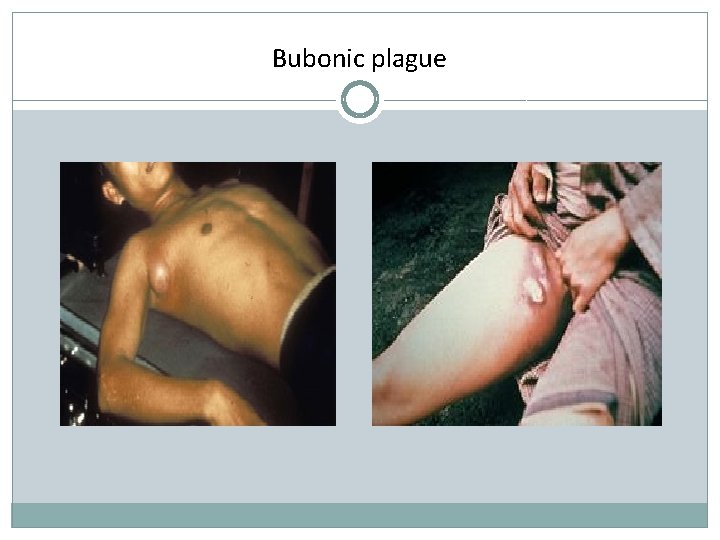 Bubonic plague 