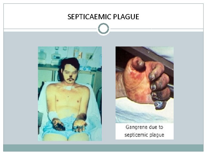 SEPTICAEMIC PLAGUE 