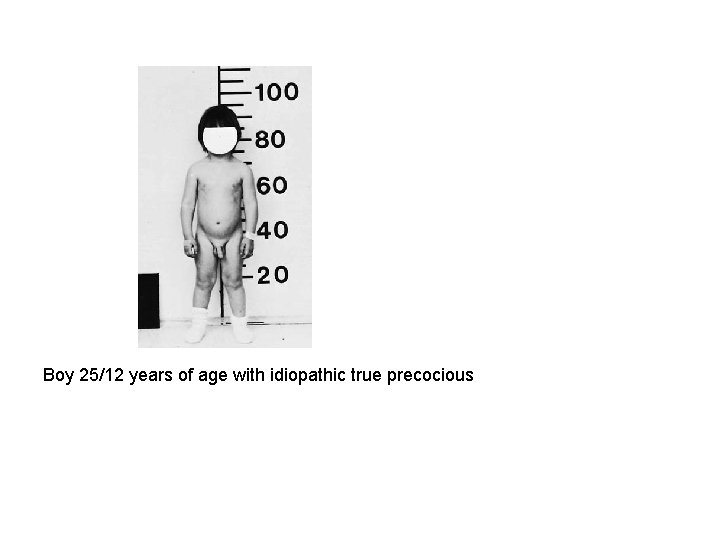 Boy 25/12 years of age with idiopathic true precocious 