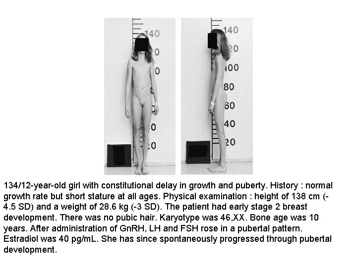 134/12 -year-old girl with constitutional delay in growth and puberty. History : normal growth