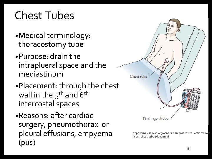 Chest Tubes • Medical terminology: thoracostomy tube • Purpose: drain the intraplueral space and