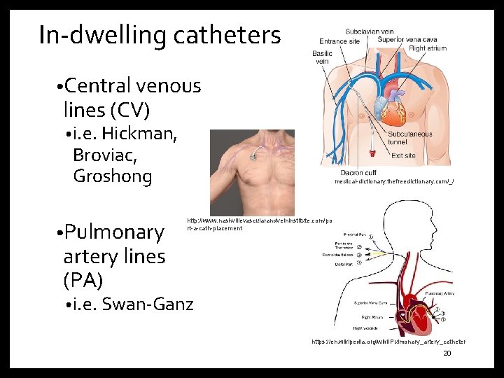 In-dwelling catheters • Central venous lines (CV) • i. e. Hickman, Broviac, Groshong •