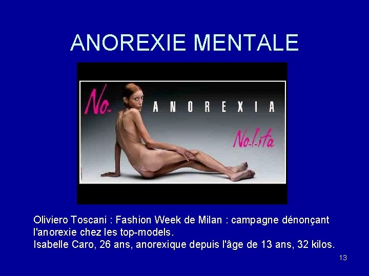 ANOREXIE MENTALE Oliviero Toscani : Fashion Week de Milan : campagne dénonçant l'anorexie chez