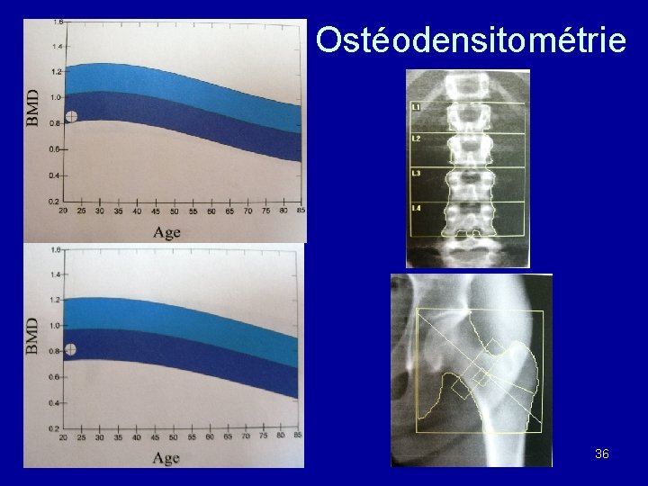 Ostéodensitométrie 36 